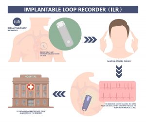 How does an implantable loop recorder work?