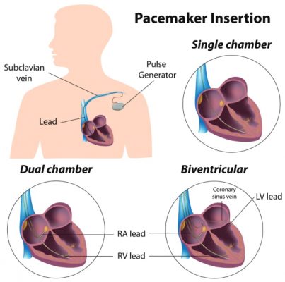 The Different Types of Pacemakers | My Rhythm Device